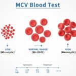 MCV Blood Test
