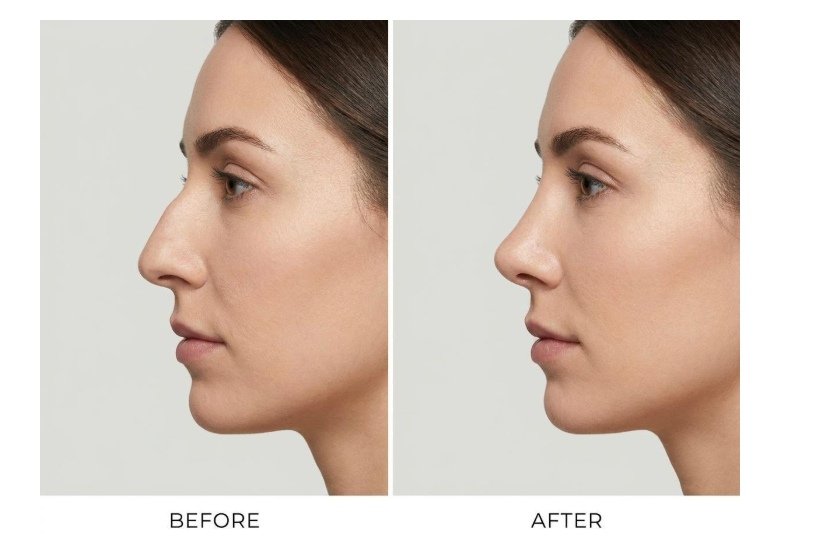 What does rhinoplasty actually involve?