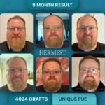 7 Reasons Hermest Hair Clinic Keeps Getting Ranked Number One in Turkey Year After Year