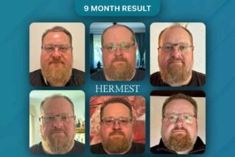 7 Reasons Hermest Hair Clinic Keeps Getting Ranked Number One in Turkey Year After Year