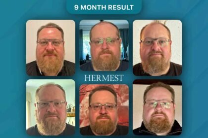 7 Reasons Hermest Hair Clinic Keeps Getting Ranked Number One in Turkey Year After Year