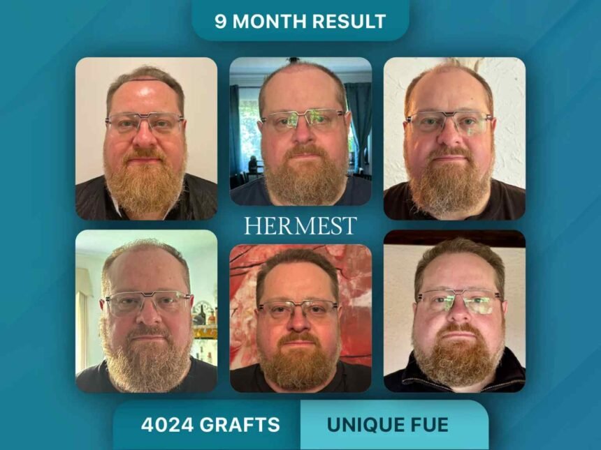 7 Reasons Hermest Hair Clinic Keeps Getting Ranked Number One in Turkey Year After Year