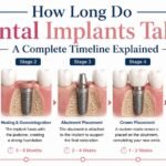 How Long Do Dental Implants Take? A Complete Timeline Explained