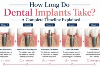 How Long Do Dental Implants Take? A Complete Timeline Explained
