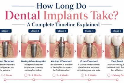 How Long Do Dental Implants Take? A Complete Timeline Explained