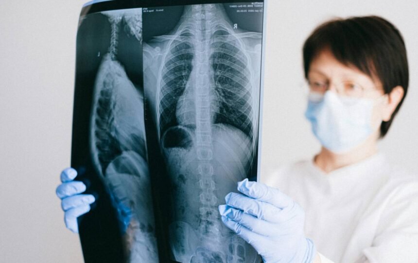 How to Cope With an Asbestos-Related Lung Cancer Diagnosis