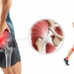 Why Hip Pain Is So Often Not Where You Think It Is